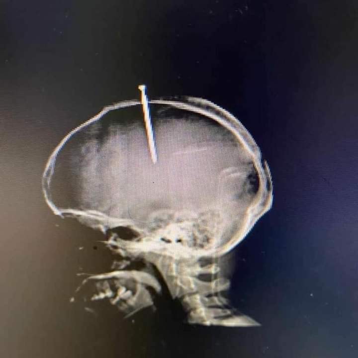 Hombre se clava la cabeza porque sentía el cerebro flojo
