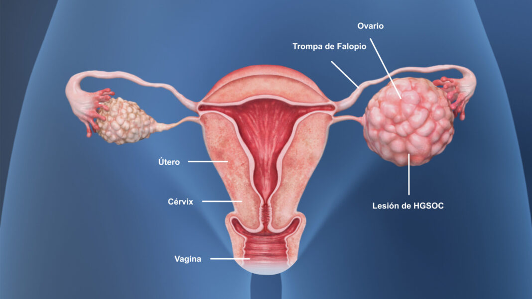 Este lunes es Día Contra Cáncer de Ovario, detectado tardíamente en RD